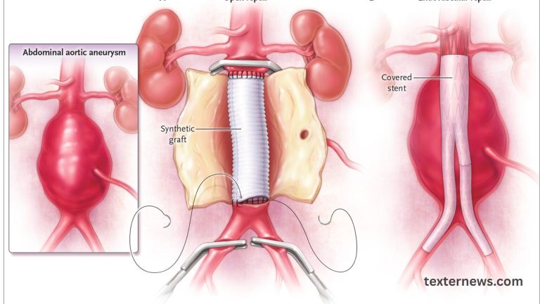 Giant Infrarenal Aortic Aneurysm Treated With Endovascular Repair